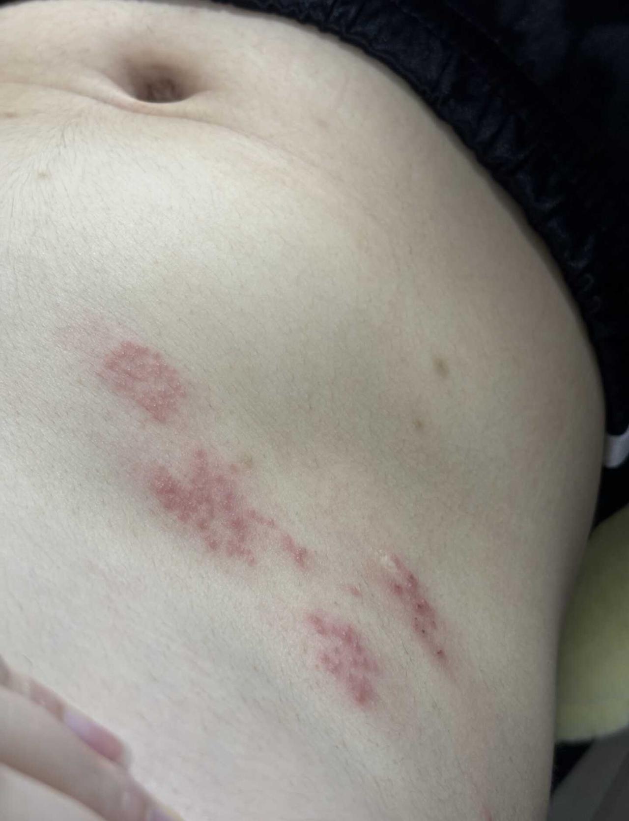 到底是什么虫子这么毒
不知道被什么虫子爬了，长了一片疙瘩，已经三四天了，痒痒的可