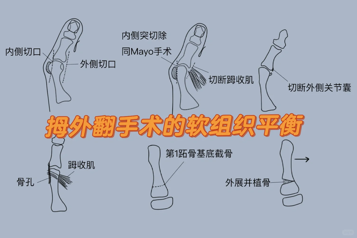 拇外翻手术的软组织平衡