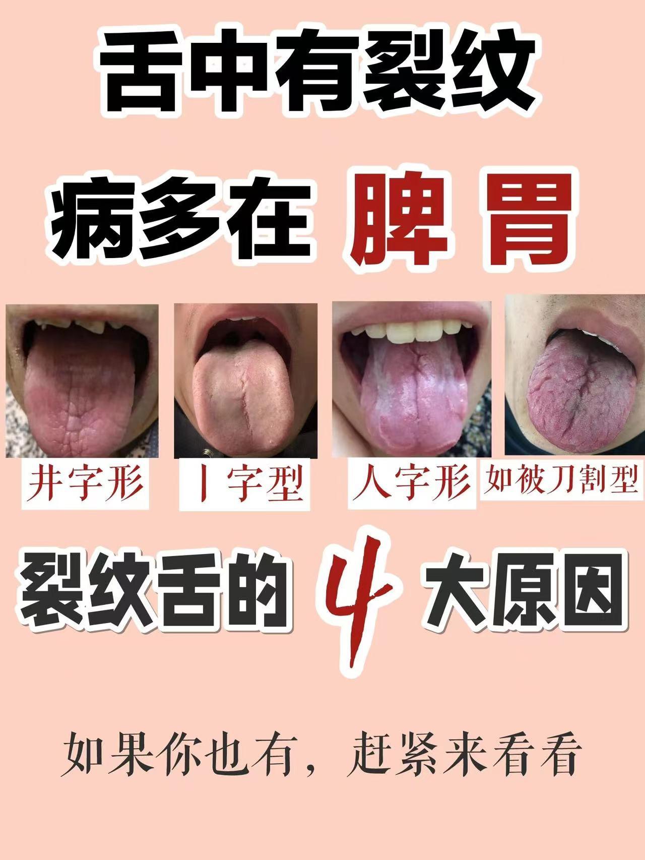 注意啦！裂纹舌与脾胃，竟藏着这么多秘密㊙️
前几天有粉丝问我：我舌头上有裂纹，好
