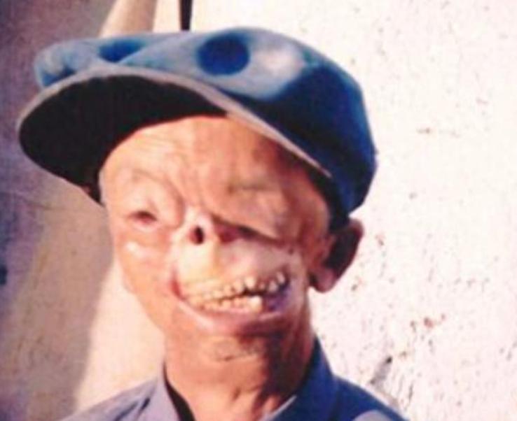 1950年，年仅3岁，就被狼咬掉了半张脸，父亲将其无情的扔到山洞中，没想到他却顽