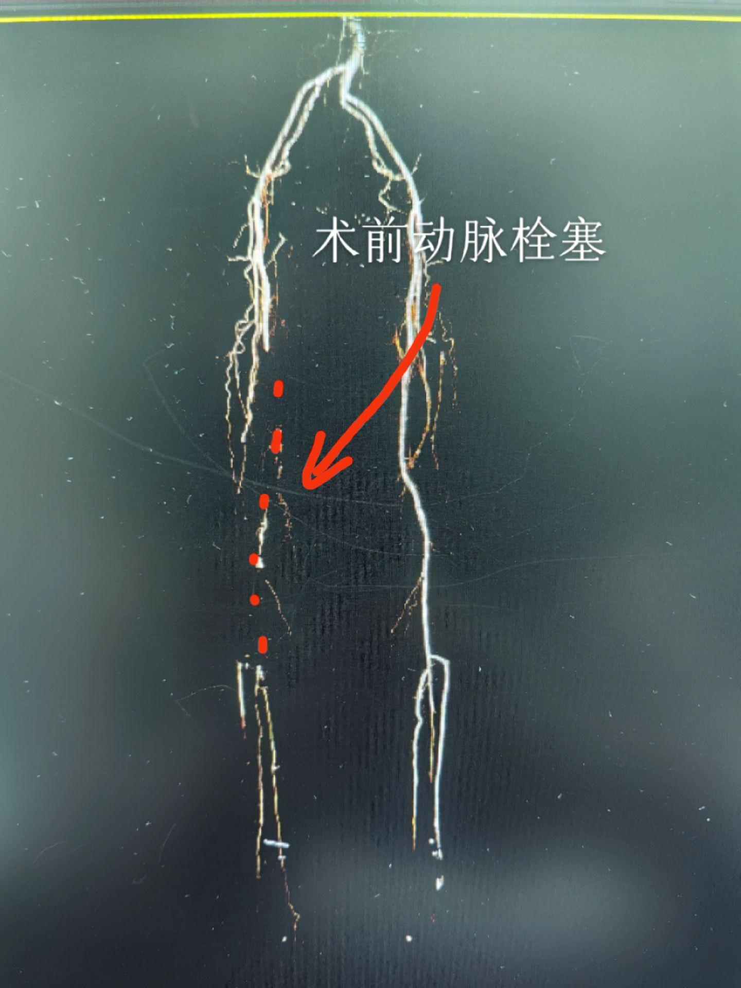 房颤心房血栓脱落引起下肢动脉栓塞，下肢冰冷、发绀，不及时处理会导致下肢...