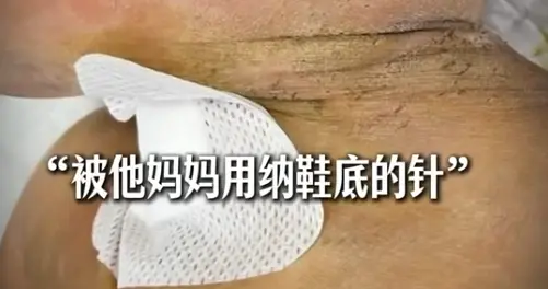 云南10个月男婴被扎数百针，系其母用民间“扎针”法自行治疗所致，其文化水平较低，缺乏科学健康知识，有