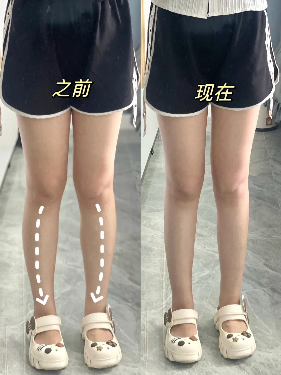 今年夏天可以美美的露腿啦～🥳🥳