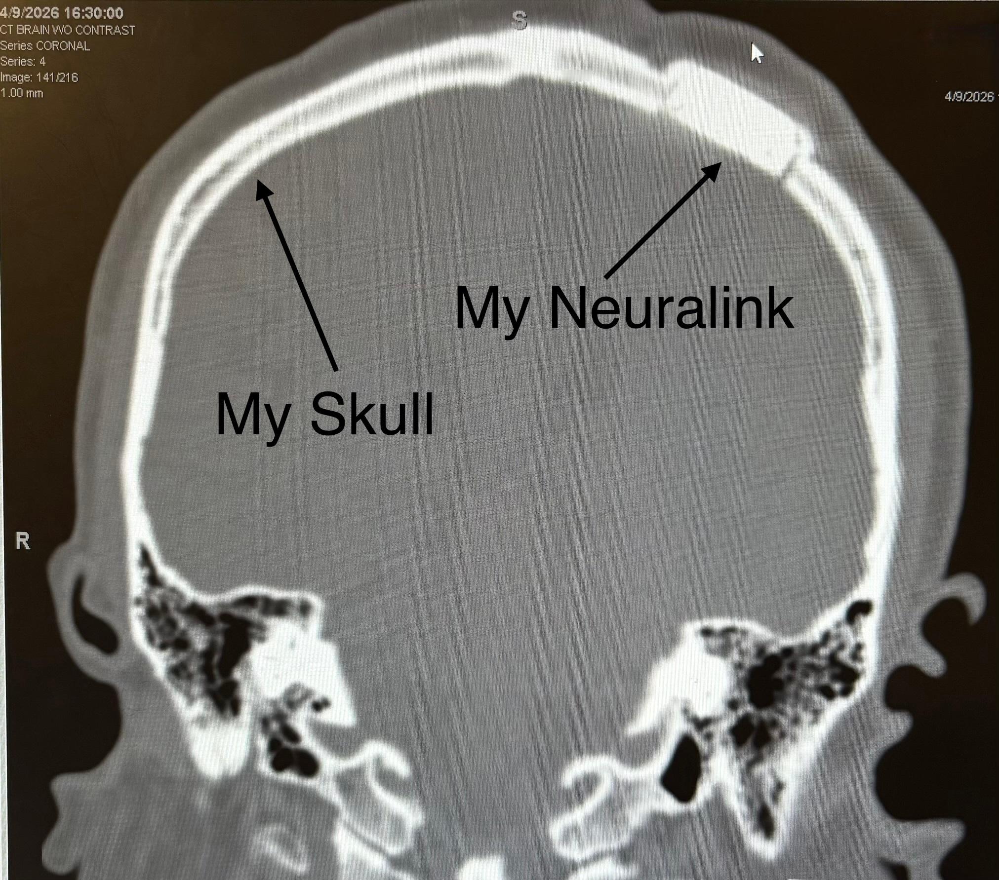 Neuralink植入者已达24位！当地时间4月10日，X网友CJ发文称，当天进