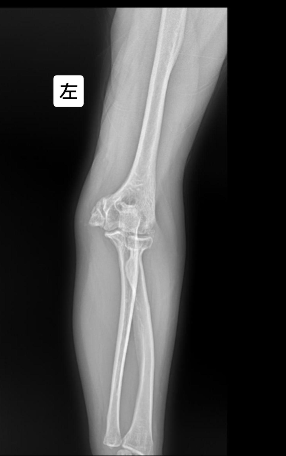 左肘关节外伤就诊