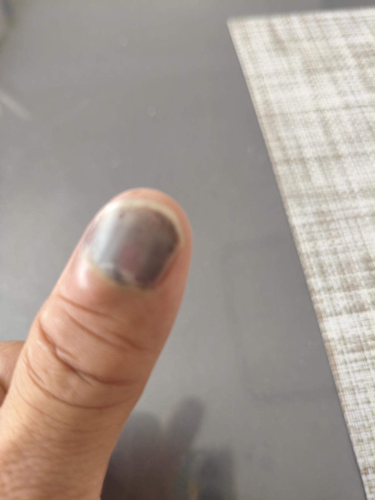 我这指甲还能保住吗？人岁数大了，真是不中用了，关个车门能把手轧成这个样子。指甲全