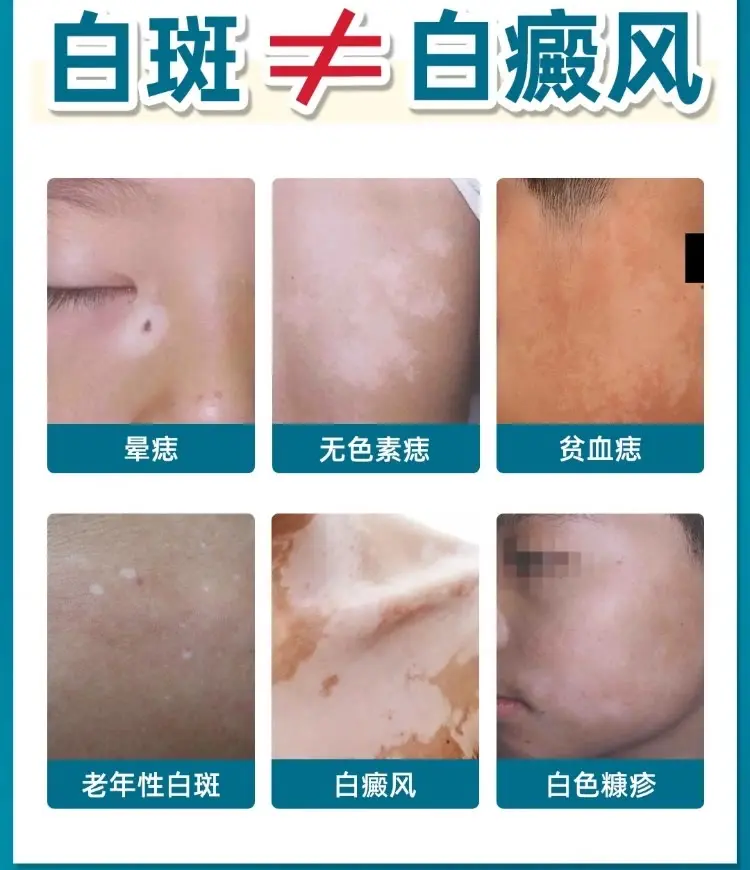 白癜风 白癜风科普 白斑 抖出健康知识宝藏 皮肤健康