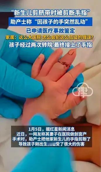 这种事情是头一回听说。一助产士给新生儿剪脐带的时候，竟然把新生儿的一节中指给剪断