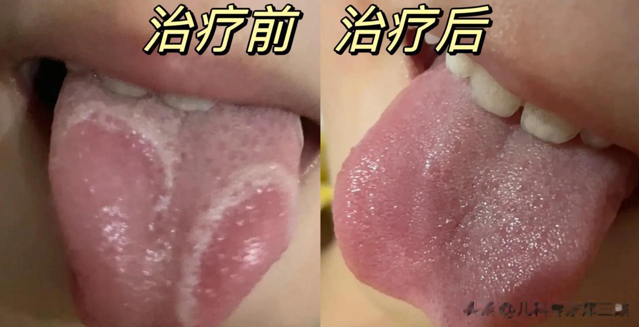 不到2个月，孩子脾胃好了，吃饭香了！大便不干了，舌苔正常了！
 
这是昨天第一个