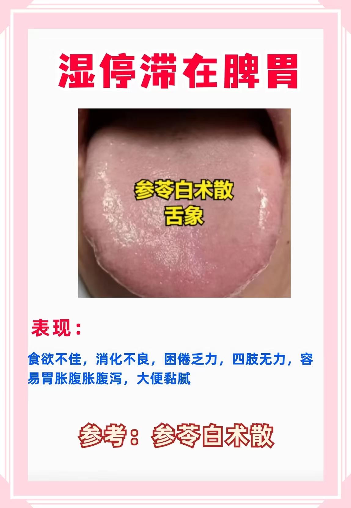 “湿在脾” 的舌象、症状和方剂对应特别精准！参苓白术散正是针对脾虚湿盛的核心方剂