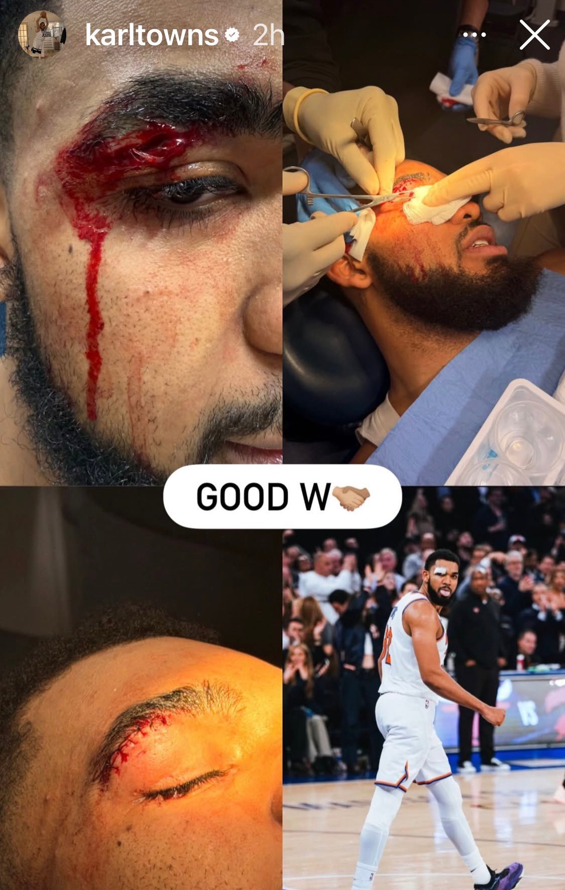 唐斯挨这一下可真不轻啊……nba