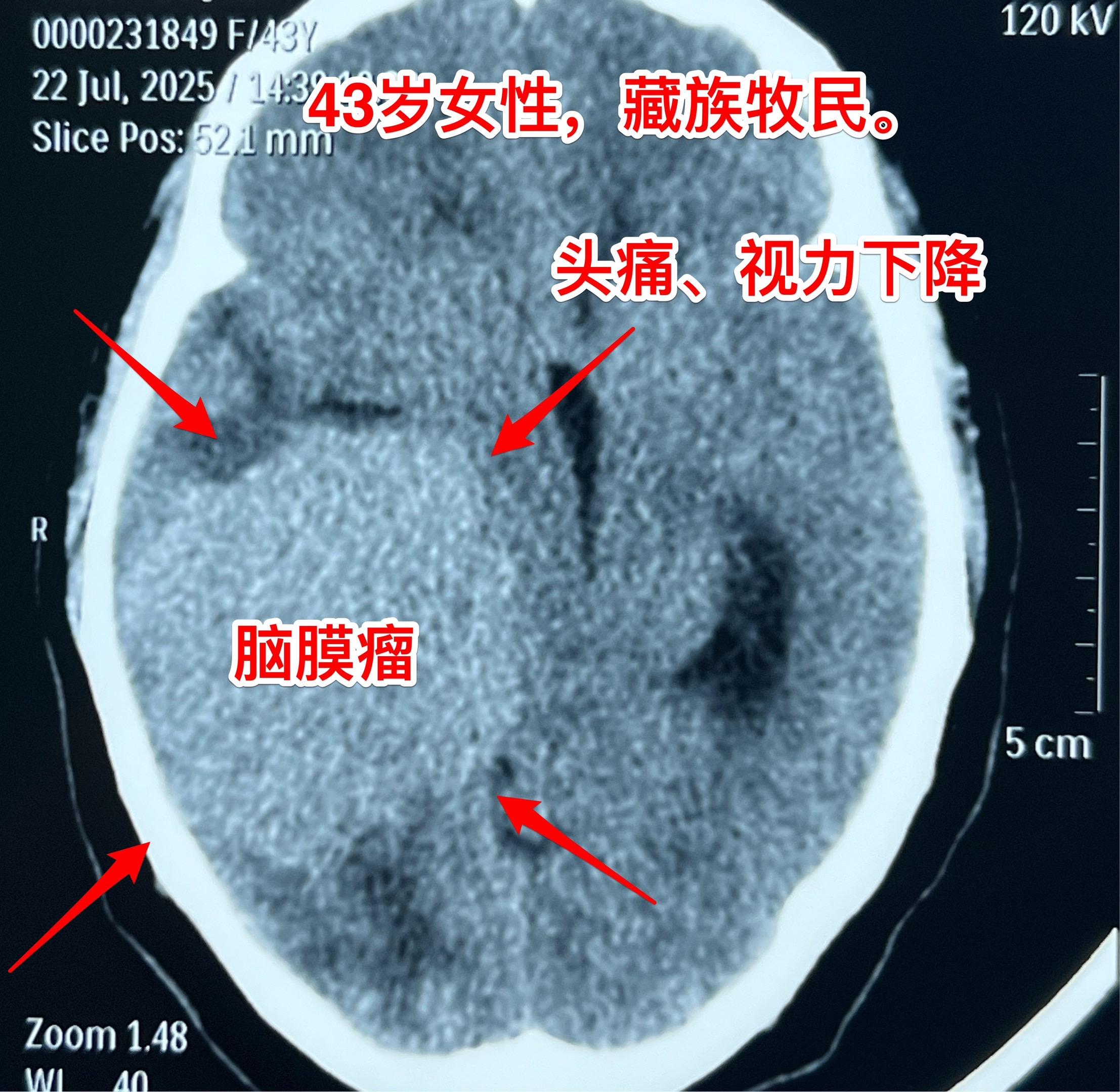 藏族牧民脑肿瘤被发现时像鸡蛋一样大。青海省黄南州藏族牧民，43岁，女性...