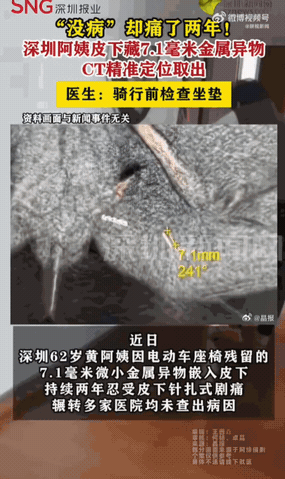 无病一身轻！广东深圳，一62岁的阿姨这两年过得可谓是备受煎熬，她隐私部位反复剧痛