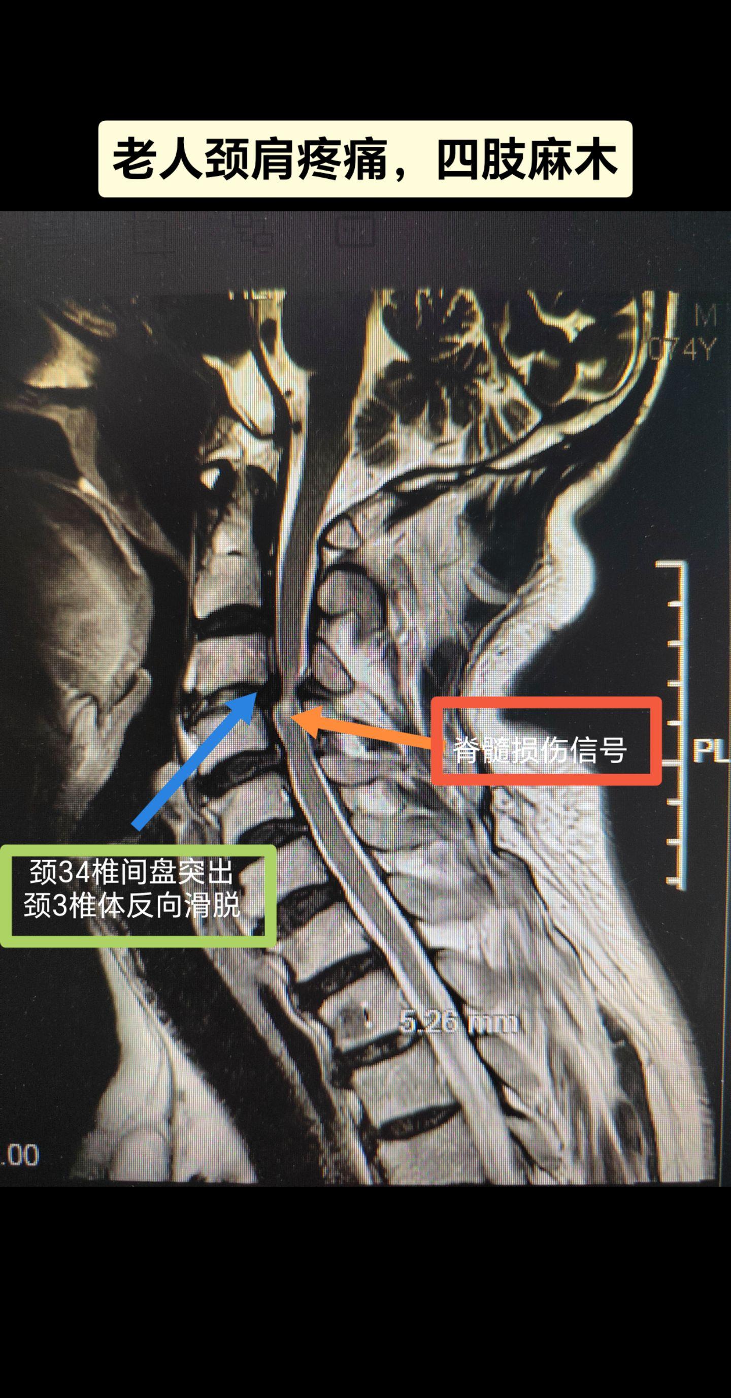 老年脊髓型颈椎病。又是一例病情拖延很久的颈椎病，麻醉醒后病人直言舒服太多了。