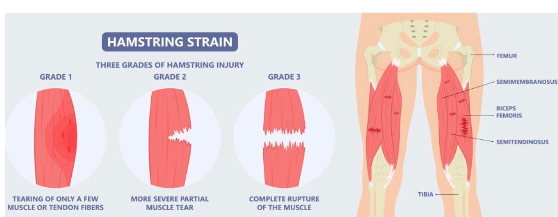 腿筋拉伤显示图！东契奇无限期休战
