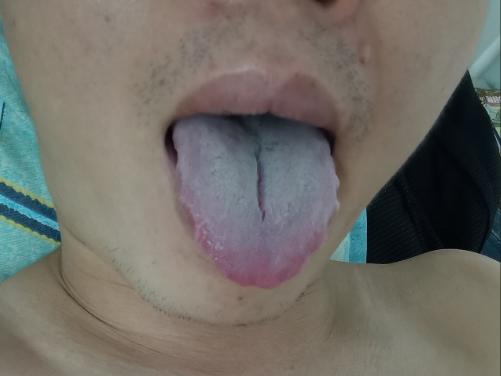 舌中裂纹不可怕，就怕你的裂纹，从舌中开裂到舌根[求抱抱]

这位患者也就31岁，
