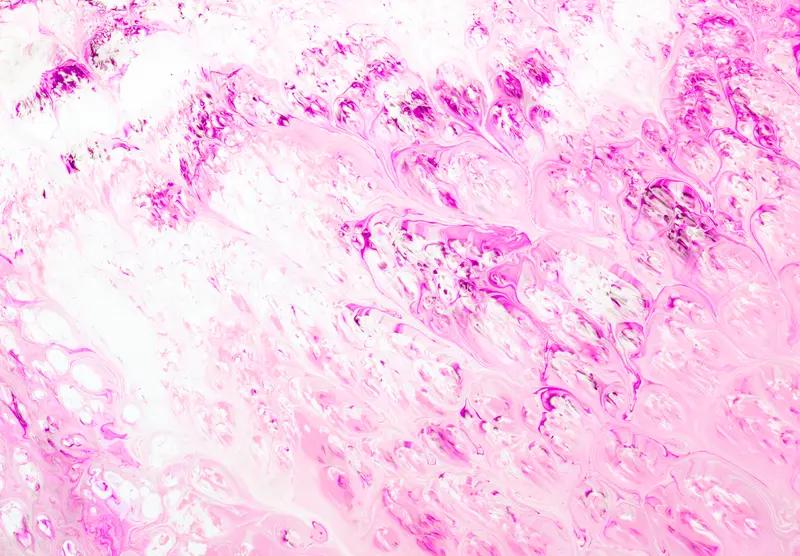 角化型鳞状细胞癌早期症状和癌细胞位置密切相关。要是长在皮肤上，早期会出现红色硬结