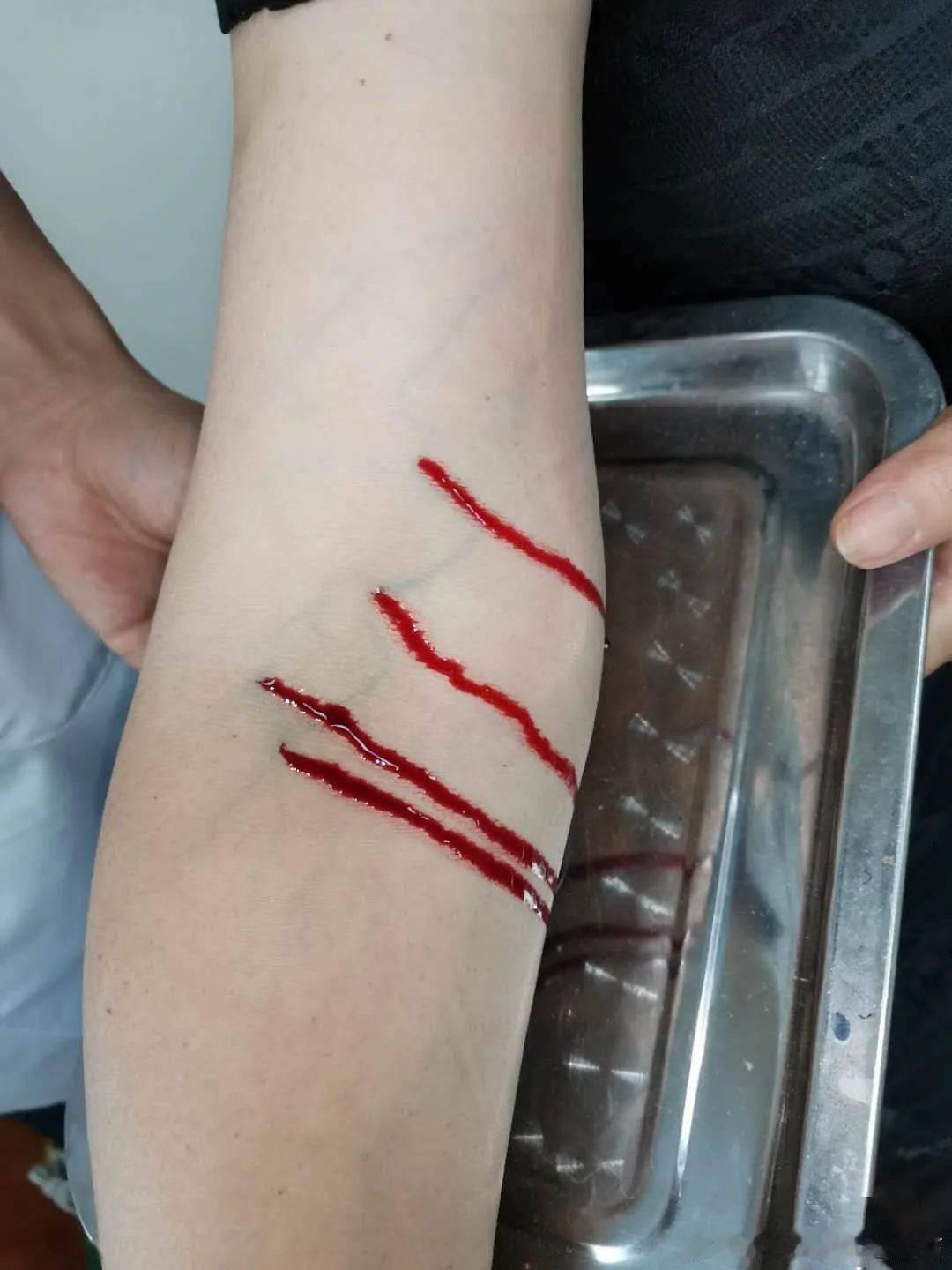 黑诊所放血疗法地面血流成泊 上海松江区一个挂着“健康咨询”牌子的出租屋里，最近上