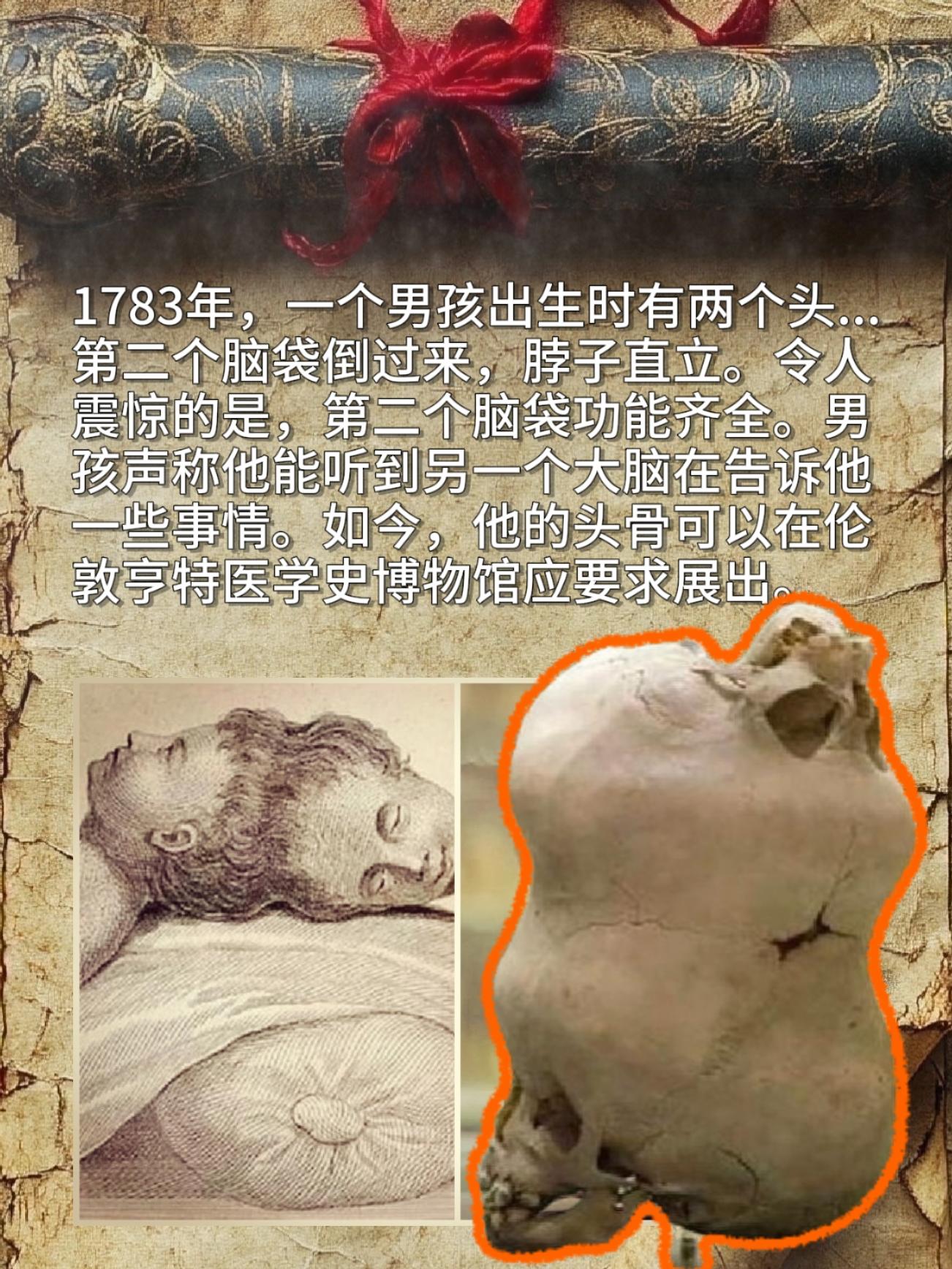 世界冷知识！1783年 一个男孩出生时有两个头...