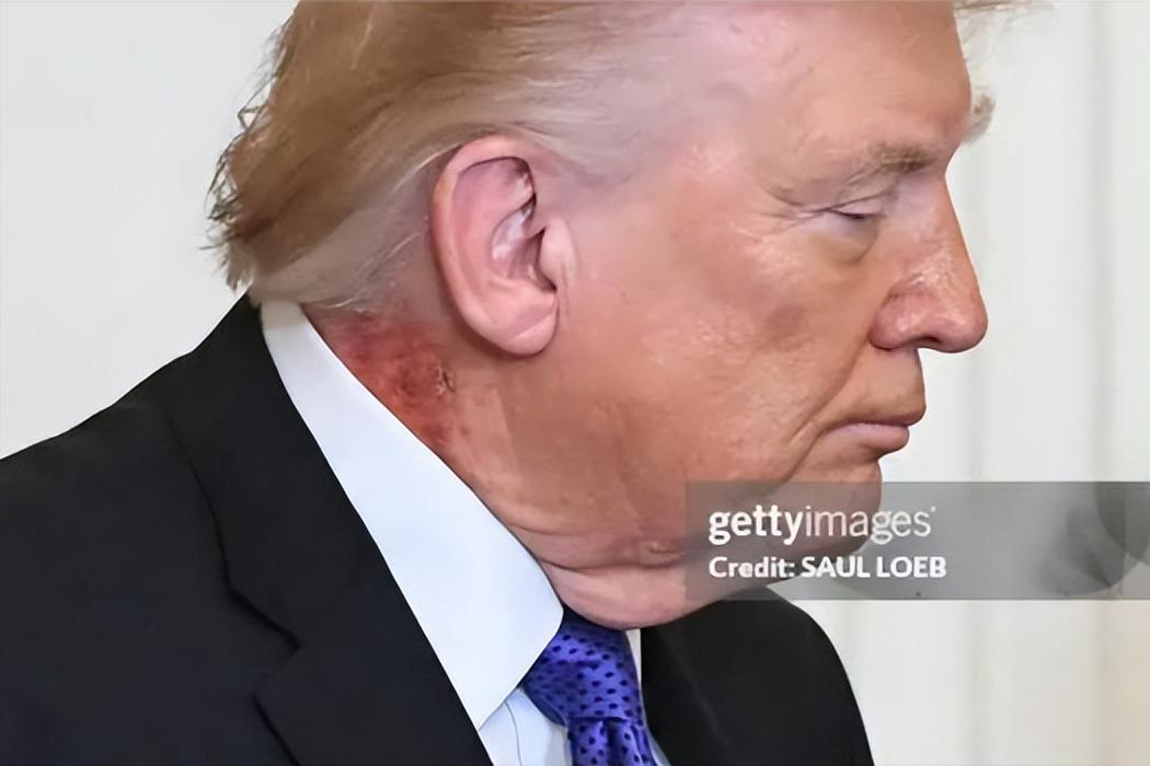 笑不活了！特朗普颈部现疑似溃烂痕迹，妥妥的抓拍名场面。

特朗普在白宫出镜时，颈