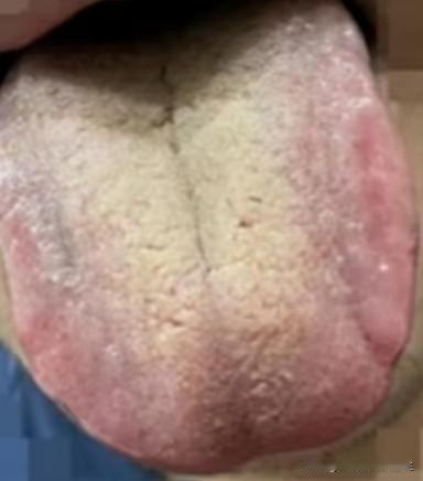 舌苔黄腻，有裂纹，中医一方，两个月调理好

患者主诉：失眠多梦，经常放屁，口干、