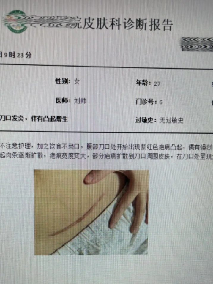 去了一趟皮肤科才发现那么多人剖腹产后留疤