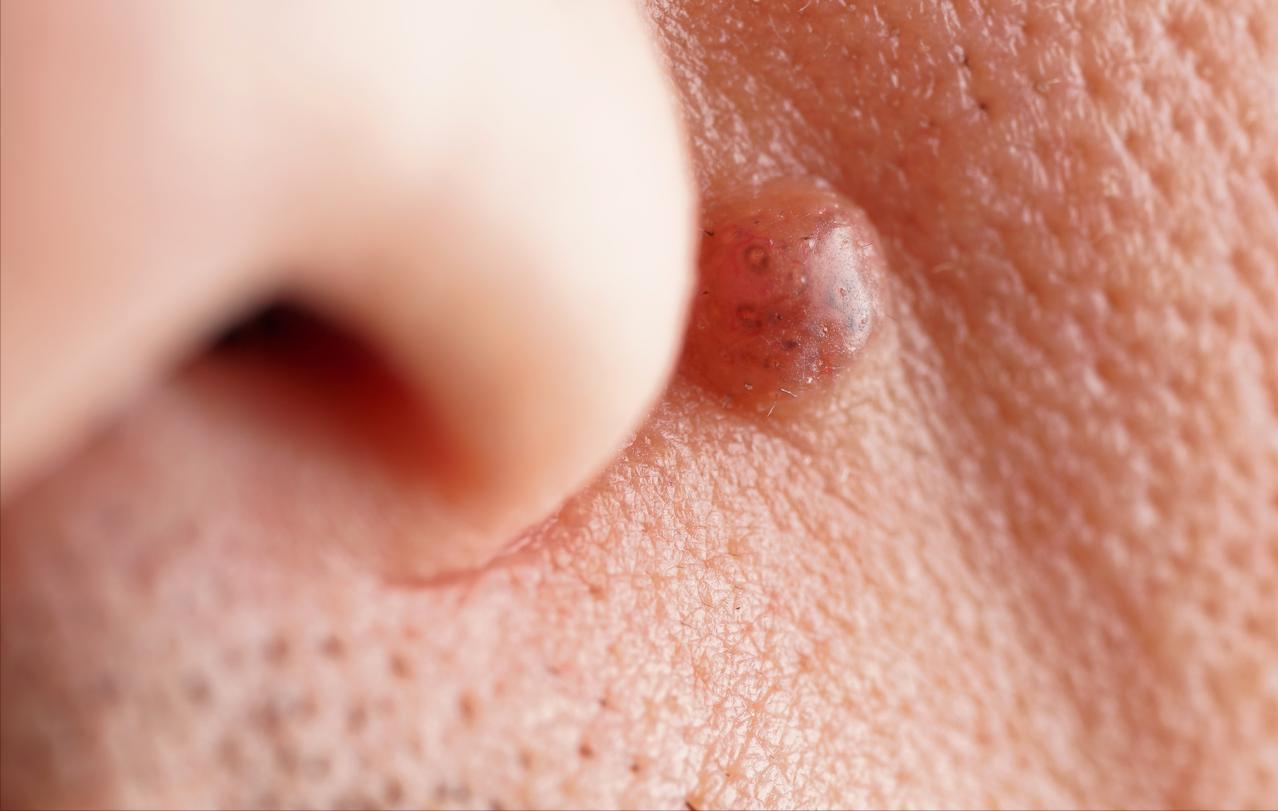 东莞男子面部痘痘挤八年，最后确诊是肿瘤，面部痘痘千万别乱挤
刚刚看到一则新闻，东