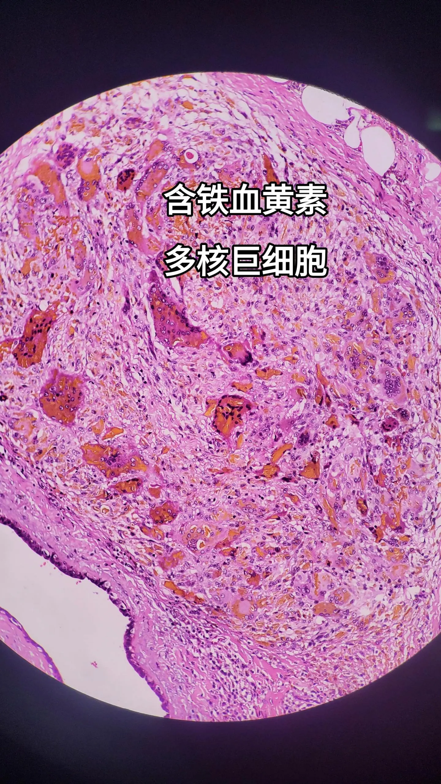 组织内出血时，从血管中逸出的红细胞被巨噬细胞摄入并由其溶酶体降解，使来...