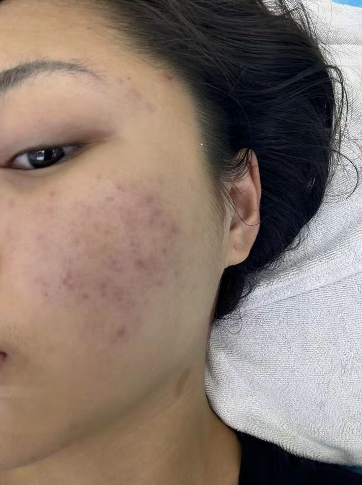 根据美容师说明，蕾特恩针对痘肌修护，成分温和代谢角质。我的方案结合净螨清洁每周1