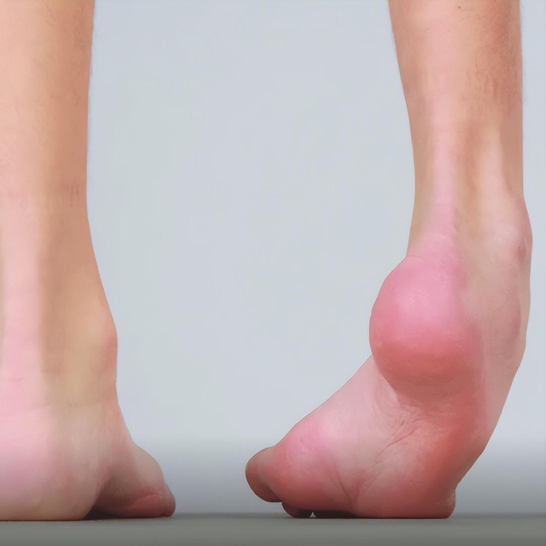 偏瘫后脚越来越“歪”？警惕这3种畸形，拖久了可能走不了路！

一、足下垂
这是最