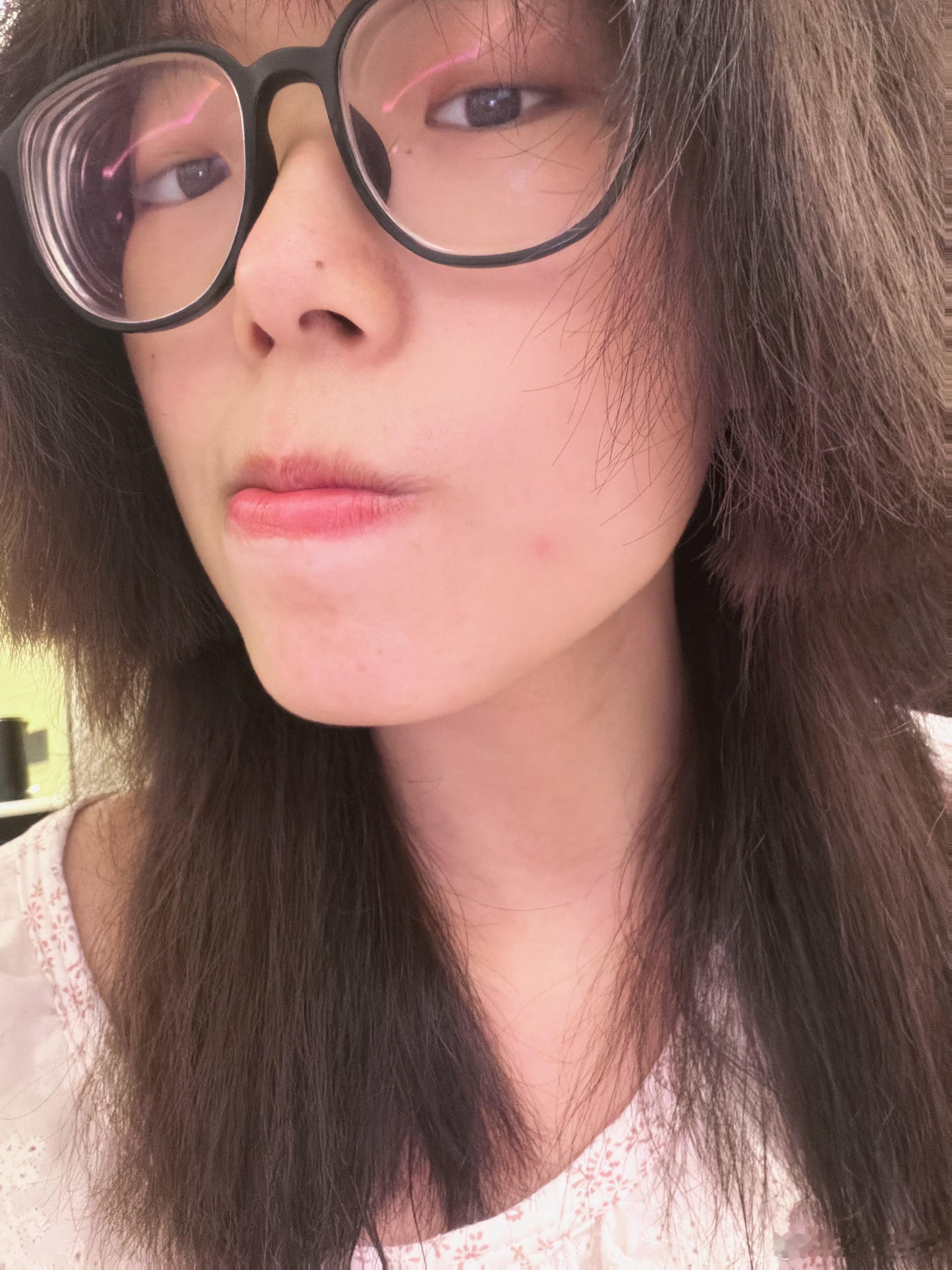 520当天长了个大痘，这是想整哪一出？还差一颗就七星连珠了🤯 