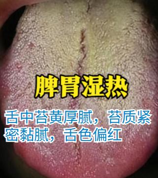 同为湿热，脾胃与大肠湿热大不同！辨证别搞错

一、脾胃湿热
脾胃湿热的核心是湿热