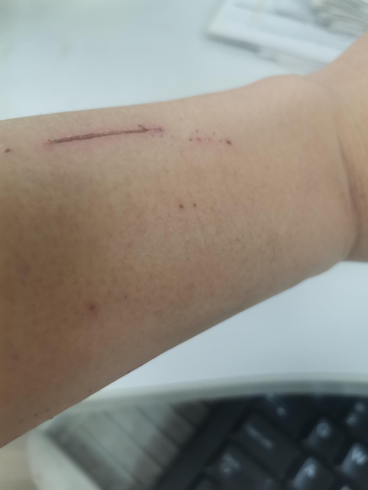 我早上起来，经常发现身上有伤，床上有血。
我的皮肤太脆了，身上又经常痒，睡着后自