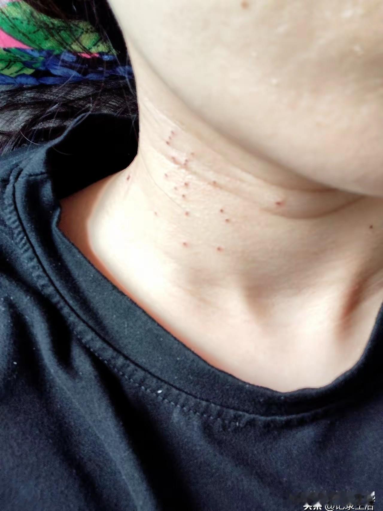 昨天我瞒着异地的老公去医院点了丝状疣，晚上视频时他发现我脖子上有激光留下的痕迹，