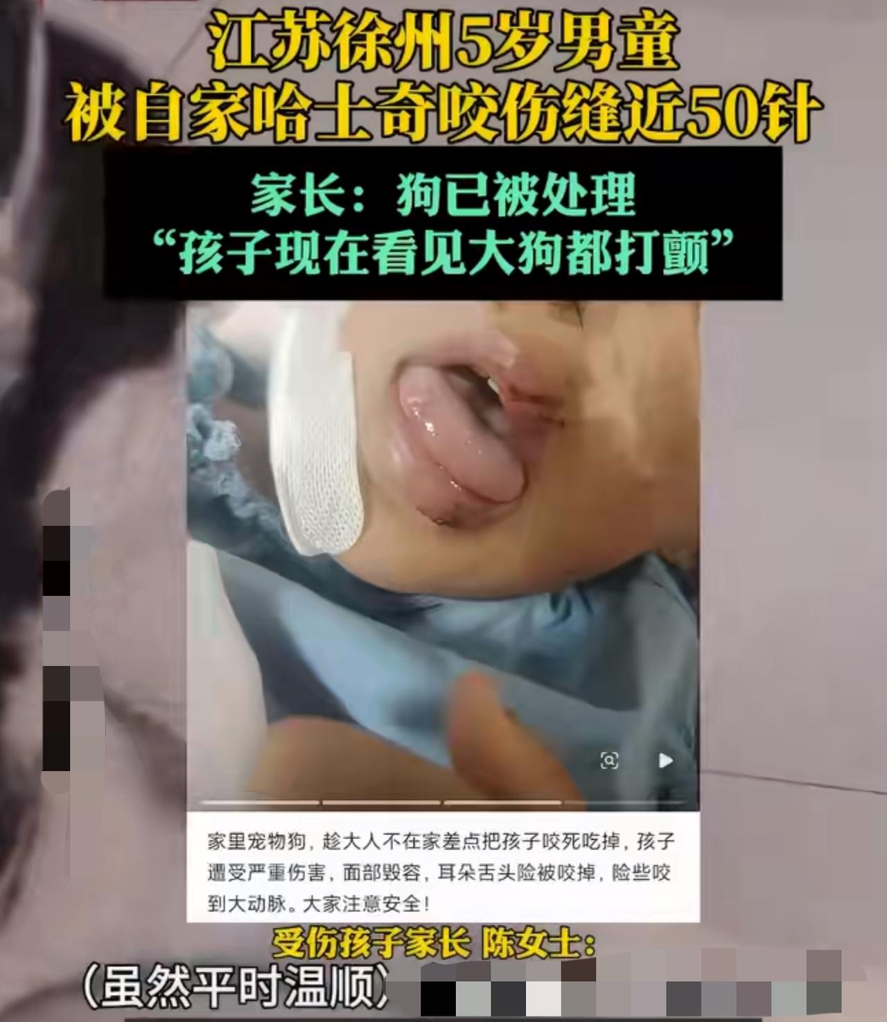江苏徐州5岁男童被自家哈士奇咬伤，缝了近50针！家长：狗已被处理，孩子现在看见大