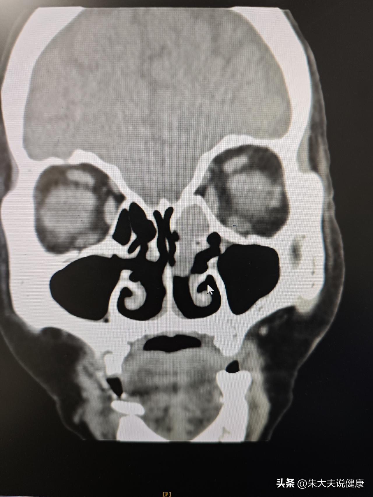 左侧鼻腔鼻窦内翻性乳头状瘤，术后三年复查，创面完全愈合，没有复发