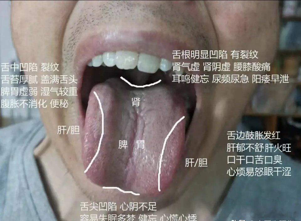 【粉丝舌象分析：口苦口臭，敏感不坚，心慌失眠】1、舌两边鼓胀发红：说明肝气不顺，