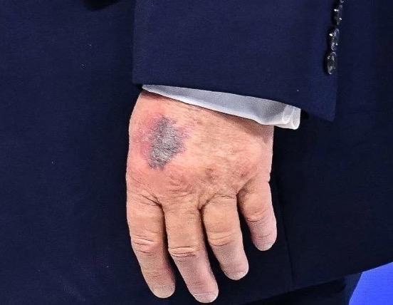 今天在瑞士达沃斯，人们可以看到特朗普左手上有明显的瘀伤。