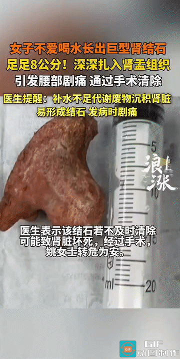 “这就是不喜欢喝水的代价吗？”江苏扬州，58岁的姚女士因腰部剧烈疼痛就医，结果连