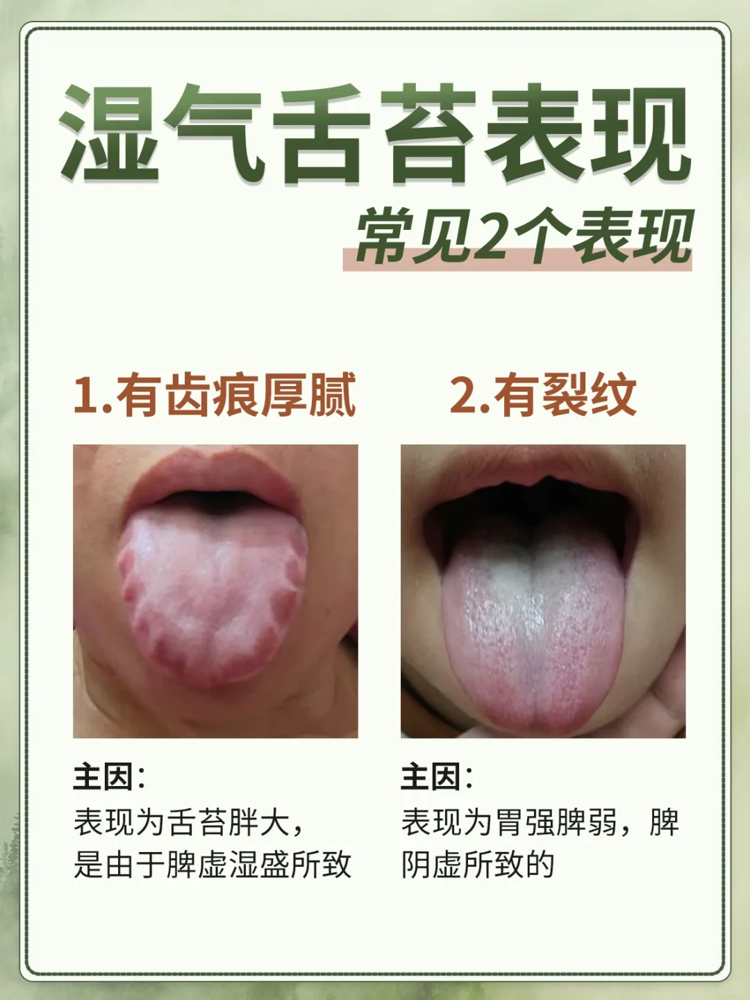 两种脾虚湿气舌苔，你是哪一种？