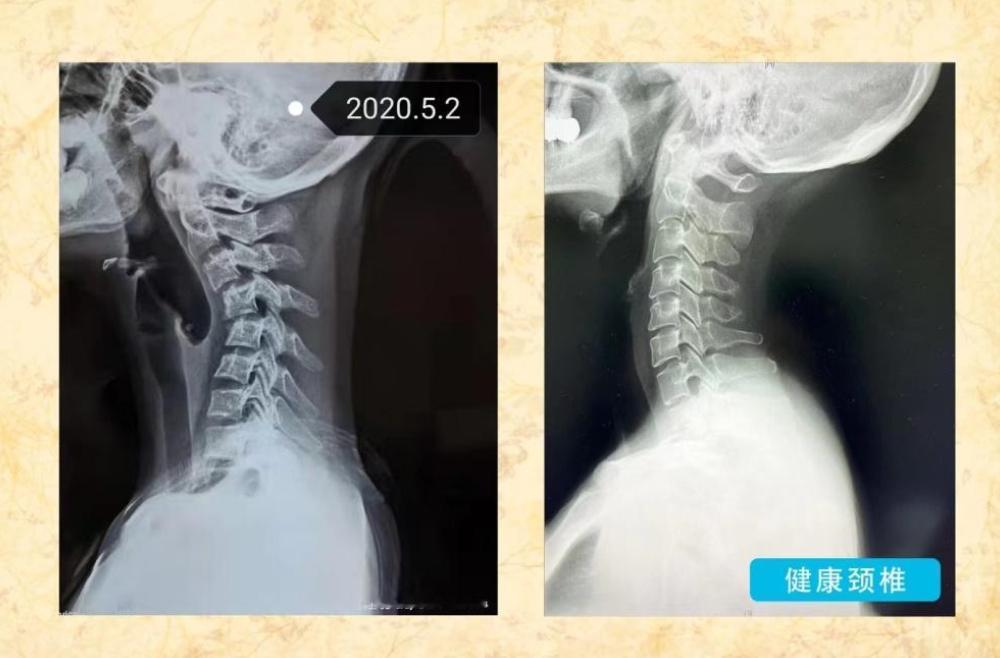 长期低头玩手机成为普遍现象，日积月累的习惯，会给颈椎带来哪些无法逆转的变化？
