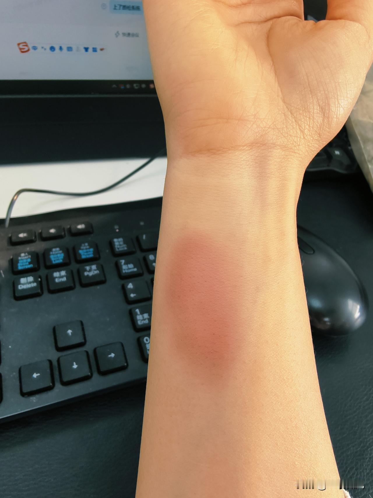 没想到一个小小的羽毛球威力这么大。前几天晚上去打羽毛球，对面打球过来的时候碰到了