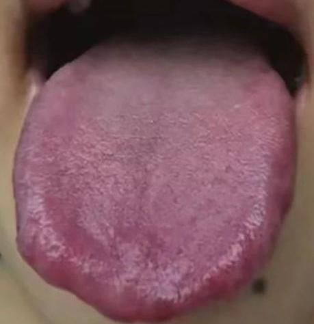 舌头越红，越不能盲目清热！越泻，火越旺！多数反而是要以补为主！
 
患者主诉：口