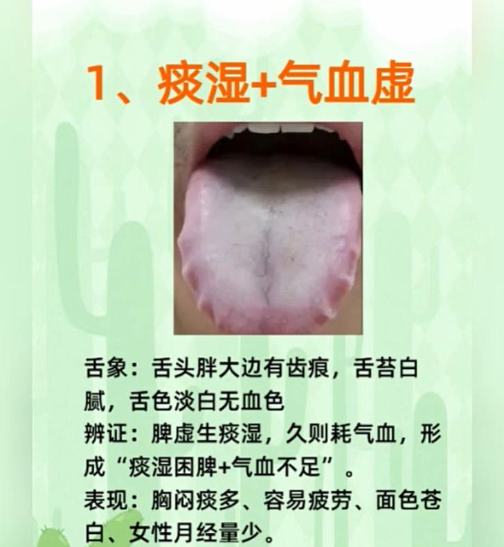 舌头胖大有齿痕、舌根苔发黄？看懂 3 类复杂体质舌象