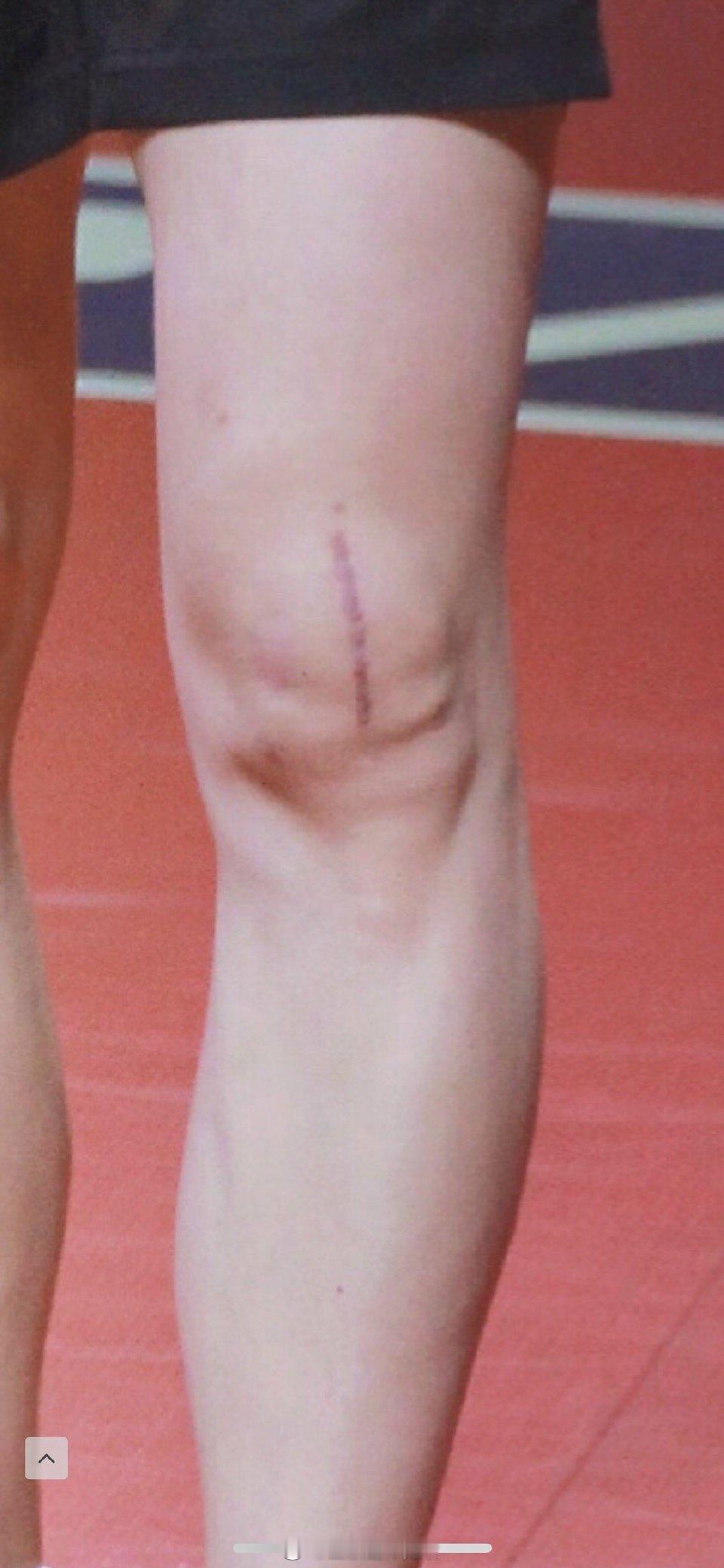 喜欢马龙的理由不单单是他取得了无以伦比的成绩，他在冲击双圈大满贯的路上做了膝盖手