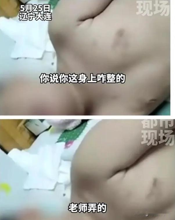 你是家长能接受吗？辽宁大连，一位幼儿园孩子回家后，家长发现孩子身上出现多处淤青，