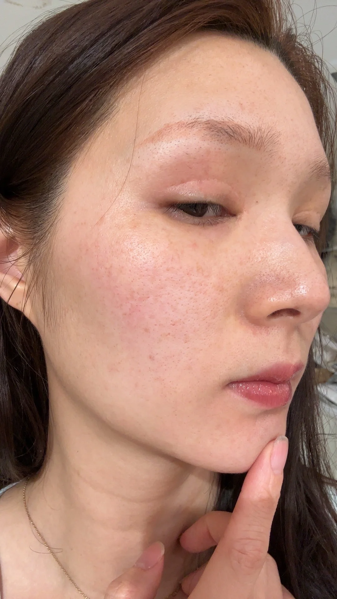 眼皮开始痒到全脸痒