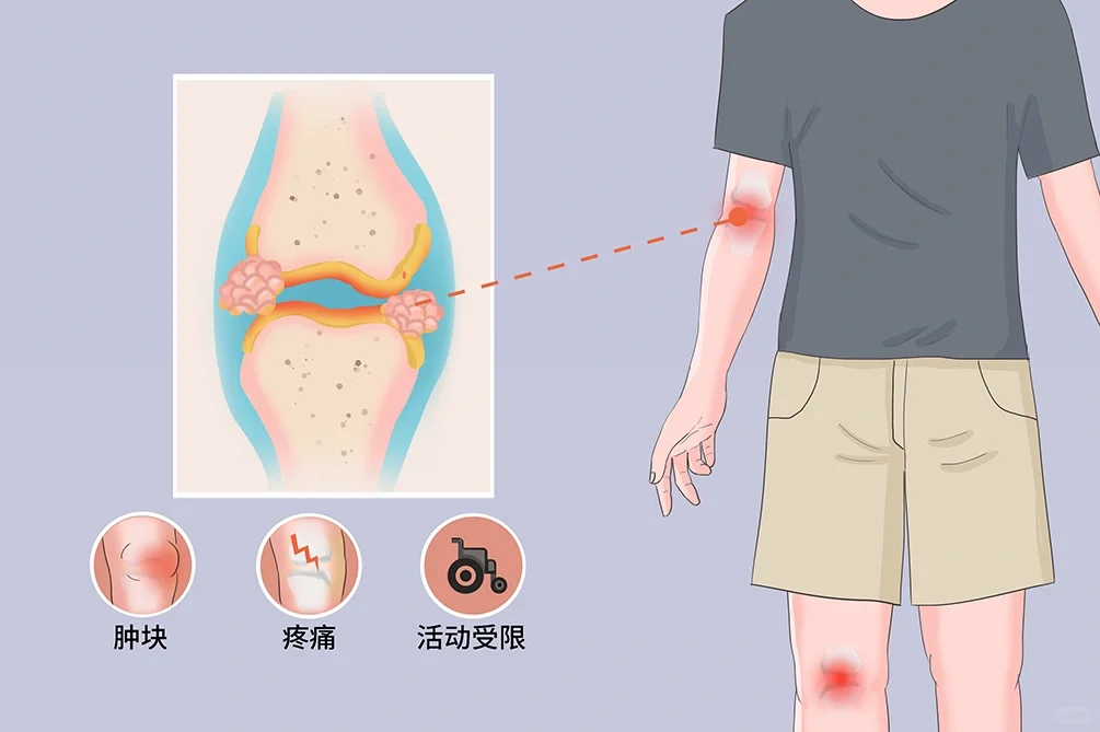 年轻人、边界清的肿物不一定良性！