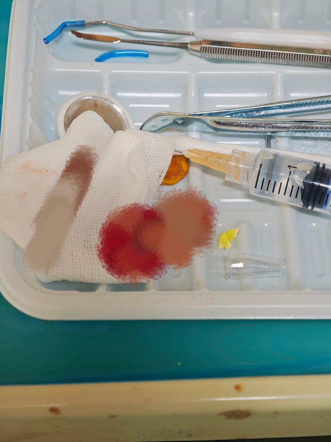 4种牙病可能跟血糖高有关是的，已经中招了，大家平时一定要注意身体健康