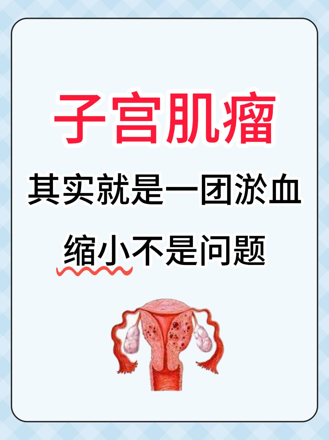 子宫肌瘤其实就是一团淤血，缩小不是问题。